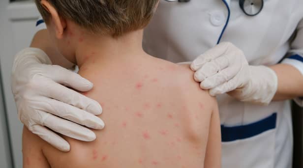 Chickenpox is a viral infection that mostly affects children, although you can get it at any age
