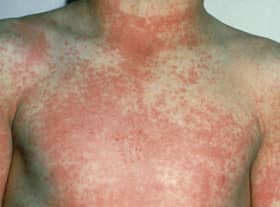 After 12 to 48 hours the characteristic fine red rash of scarlet fever develops