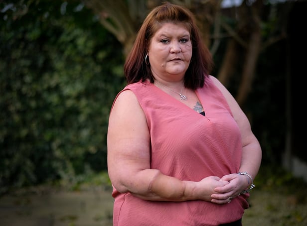 <p>Rachel Anderson of Skegness, Lincolnshire after recovering from a horrific dog attack.</p>
