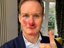 Dan Walker says he has no memory of the crash which left him bloody and bruised. Credit: Dan Walker
