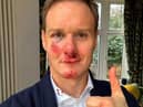 Dan Walker says he has no memory of the crash which left him bloody and bruised. Credit: Dan Walker