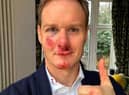 Dan Walker says he has no memory of the crash which left him bloody and bruised. Credit: Dan Walker