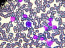 New treatment for children and adults with leukaemia (photo: Getty Images/iStockphoto)