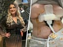 Sara Platt during happier times (L) and her right breast died and she contracted an anti-biotic resistant infection after a ’botched’ Turkish cosmetic surgery (R). (Sara Platt / SWNS)