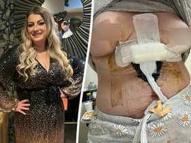 Sara Platt during happier times (L) and her right breast died and she contracted an anti-biotic resistant infection after a ’botched’ Turkish cosmetic surgery (R). (Sara Platt / SWNS)