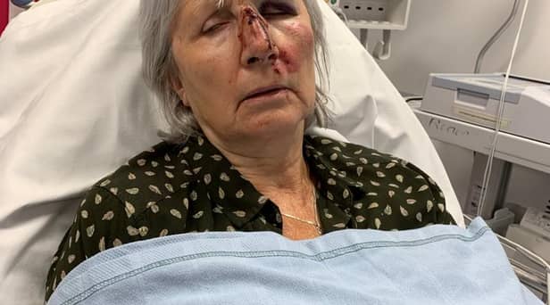 Glenn Lilley after she fell face first into the door as she collapsed before the tumour was discovered. 