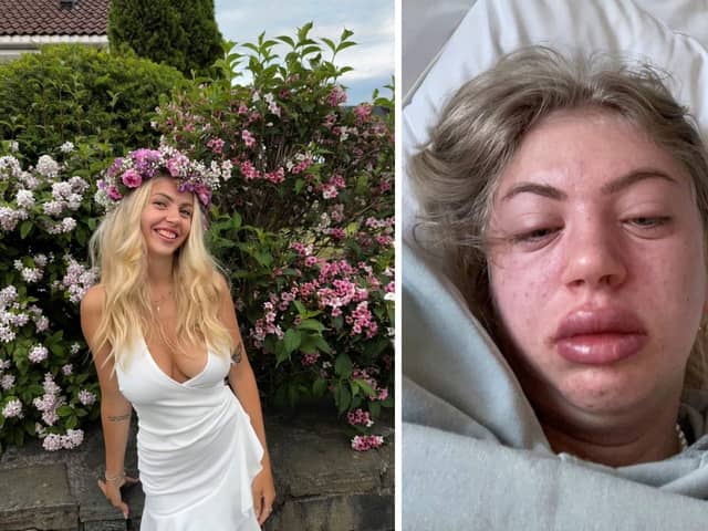 Silje Søndrål Reinertsen has become allergic to "everything" due to a rare condition. (Picture: SWNS)