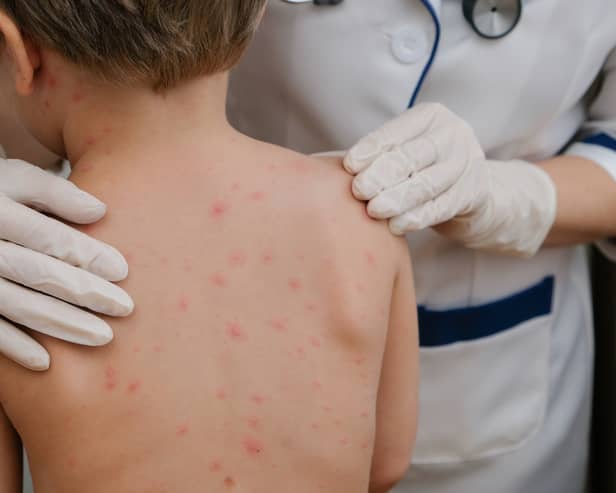 The Joint Committee on Vaccination and Immunisation has recommended that the NHS admminister the chickenpox vaccine to children aged 12 months to 18 months. (Credit: Adobe)