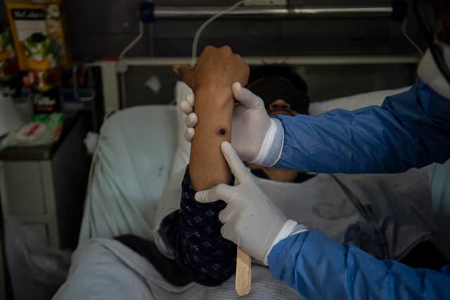 A doctor checks on a patient with sores caused by a mpox infection.