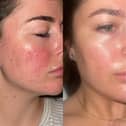 These are before and after images of Jamie, another 47 Skin user
