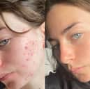 Fight breakouts with 47 Skin and the revolutionary skincare ingredient you’ve properly never heard of 