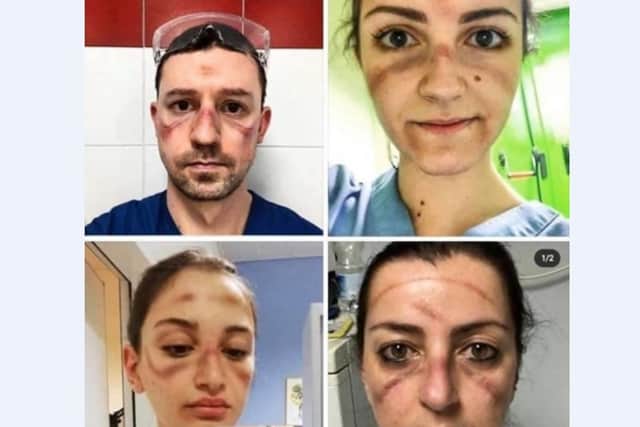 Health workers show off bruising from wearing face masks