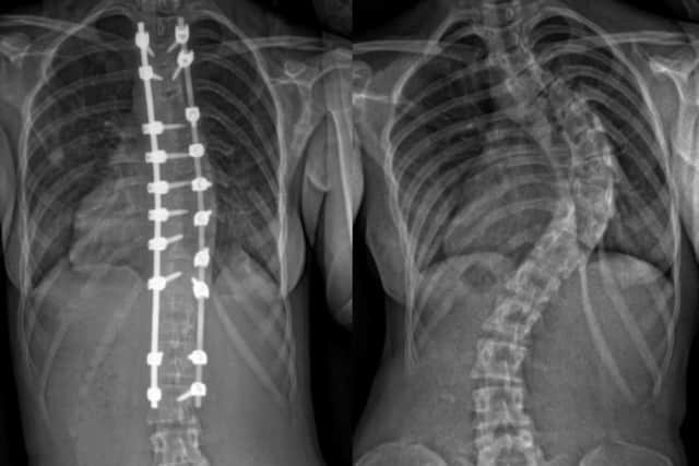 X-rays of Macey's spine before and after surgery