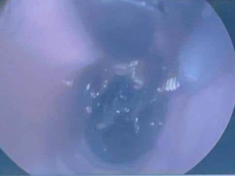 The first glove is located in Rambo's stomach through the endoscopy