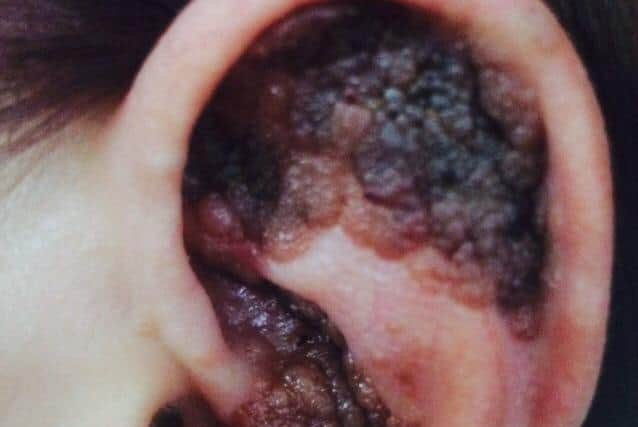 Anthea Smith's ear before amputation
