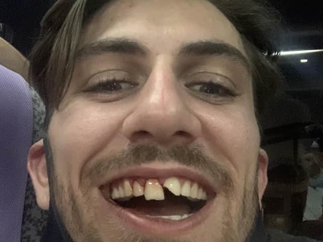 A close-up of Harry Coppull's painful start to his Olympic adventure (Pic: Harry Coppull twitter)