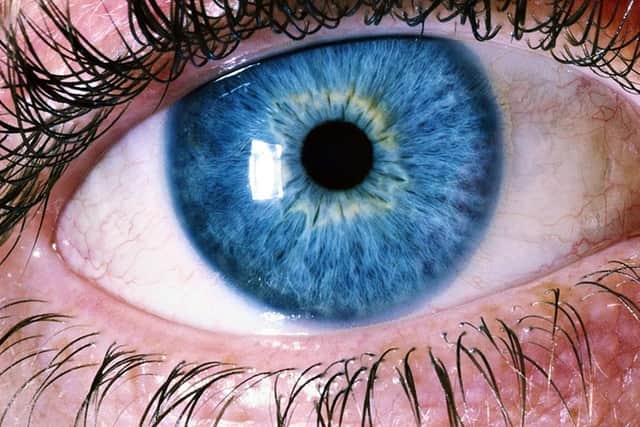 People with certain eye conditions have an increased risk of developing dementia, according to a new study.