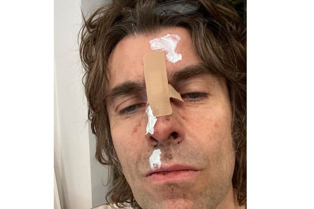 Liam Gallagher says he fell out of a helicopter