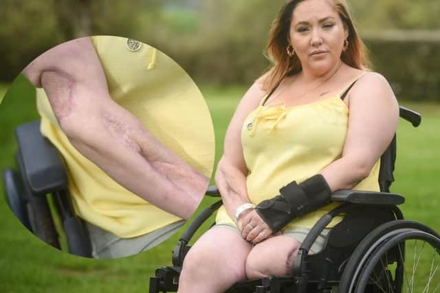 Emma Doherty has been left permanently disfigured and in a wheelchair after contracting necrotising fasciitis , also known as the 'flesh-eating disease'.