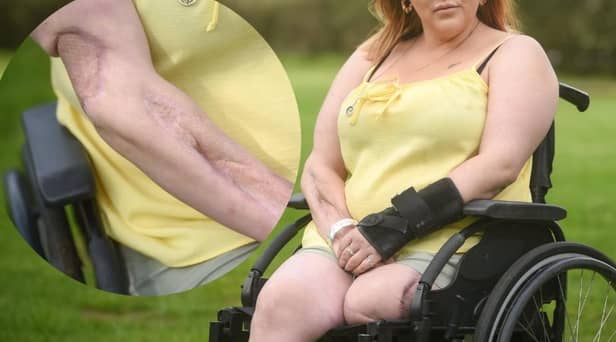 Emma Doherty has been left permanently disfigured and in a wheelchair after contracting necrotising fasciitis , also known as the 'flesh-eating disease'.