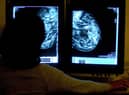 Hundreds fewer cancers were diagnosed in Wigan in 2020