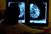 Hundreds fewer cancers were diagnosed in Wigan in 2020
