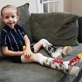 Levi Hewitt, five, wears splints as his legs recover from his battle with meningitis and sepsis