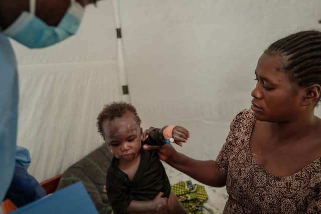 A child his helped by her mother as a health worker looks on at the Mpox treatment centre at Nyiragongo General Referral Hospital, north of Goma on August 17, 2024. With around 16,000 cases recorded since the beginning of the year, the DRC is the focus and epicentre of the epidemic that led the World Health Organisation (WHO) to trigger its highest level of alert at the international level on Wednesday. The province of South Kivu records around 350 new cases per week, according to Dr Justin Bengehya, epidemiologist at the provincial health division of South Kivu. Goma, capital of the province of North Kivu, almost surrounded by an armed rebellion and where hundreds of thousands of displaced people are crammed into makeshift camps, fears a large-scale spread due to promiscuity. (Photo by GUERCHOM NDEBO / AFP) (Photo by GUERCHOM NDEBO/AFP via Getty Images)