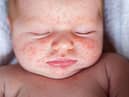 Scarlet Fever rash