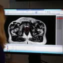 New figures from NHS England show there were 2,088 men registered with prostate cancer in the NHS Greater Manchester Integrated Care Board in 2022 – a 14 per cent increase on the year before