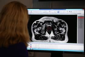 New figures from NHS England show there were 2,088 men registered with prostate cancer in the NHS Greater Manchester Integrated Care Board in 2022 – a 14 per cent increase on the year before