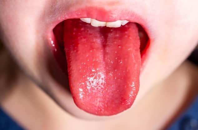 The tongue of a child with scarlet fever, known as 'strawberry tongue'