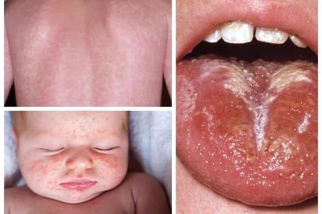 Symptoms of scarlet fever, which can be caused by group A strep