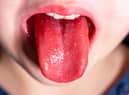 Tongue of a child with scarlet fever - strawberry tongue.