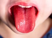 Tongue of a child with scarlet fever - strawberry tongue.