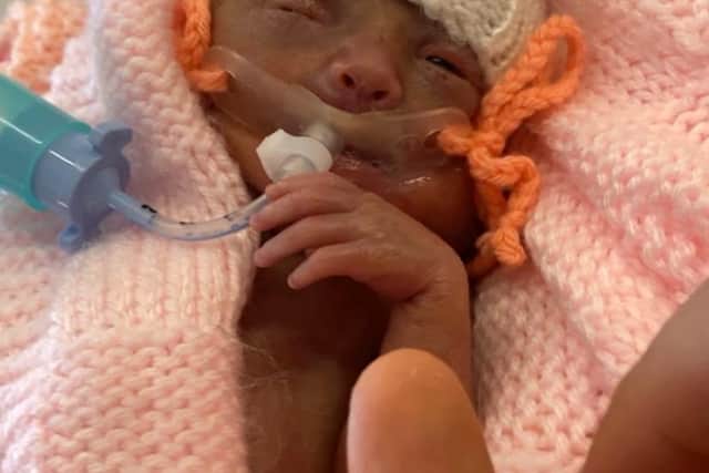 Myla-Rae Downs was born prematurely