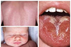 Scarlet Fever symptoms