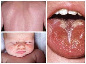 Scarlet Fever symptoms