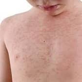 Measles cases are on the increase in the North West