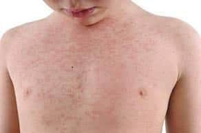 Measles cases are on the increase in the North West