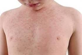 Measles cases are on the increase in the North West