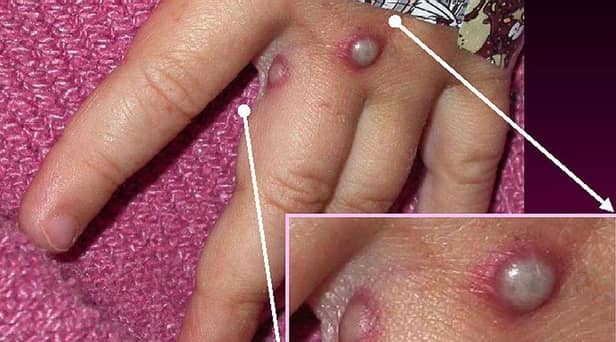 In this Centers for Disease Control and Prevention handout graphic, from 2003, symptoms of one of the first known cases of the monkeypox virus are shown on a patient's.(Photo: CDC/Getty Images)