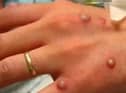 A suspected case of monkeypox has been found in Wigan