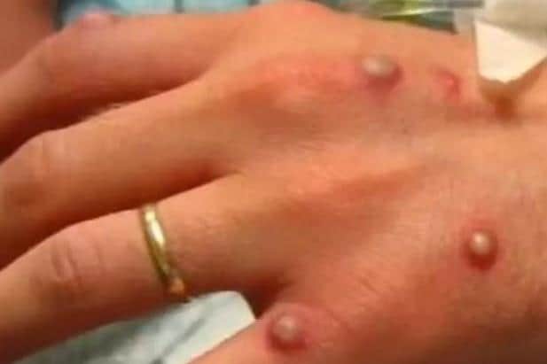 A suspected case of monkeypox has been found in Wigan