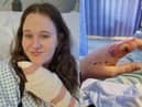 Crystal (left) and her left index finger just before her surgery.