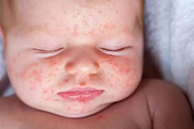 There were reports of scarlet fever breaking out among Wigan children - a foretaste of the more recent and more dangerous - strep A side-effects from the illness which have claimed several UK youngsters' lives.