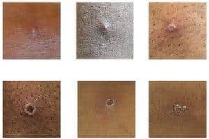 Examples of monkeypox rashes