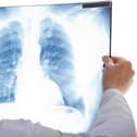 The initiative has not only diagnosed early stages of cancer but respiratory and cardiovascular disease too.