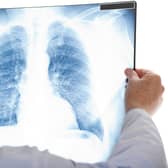 The initiative has not only diagnosed early stages of cancer but respiratory and cardiovascular disease too.
