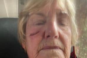 Kath Millett suffered a cut on her face and other injuries when she fell over an e-scooter